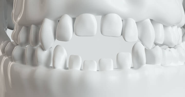 Consecuencias del uso prolongado del chupete - Adeslas Dental Consecuencias del uso prolongado del chupete - Adeslas Dental
