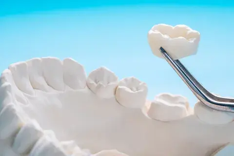 coronas de zirconio