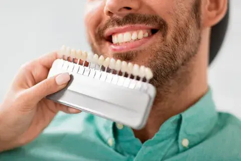 Escala de color de los dientes: cuántos blancos hay