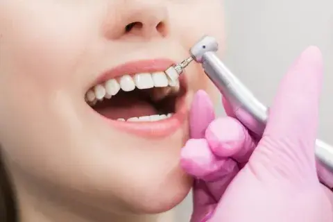 Sonrisa de mujer tratamiento de tartrectomia
