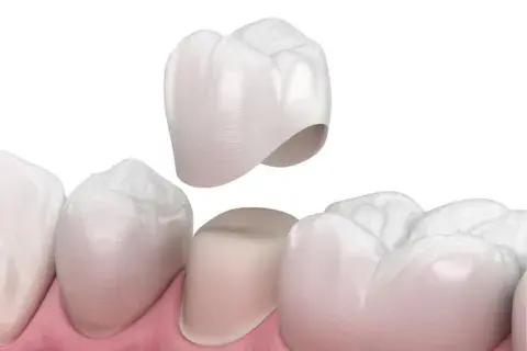 ¿Para qué sirve una funda dental?