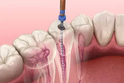 Endodoncia unirradicular: qué es y cuándo es necesaria