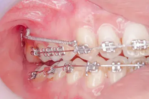 microimplantes dentales