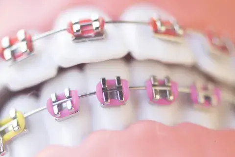 dientes-brackets-falsos