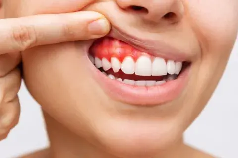 absceso_periapical_que_es_tratamientos