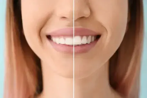 gingivectomia