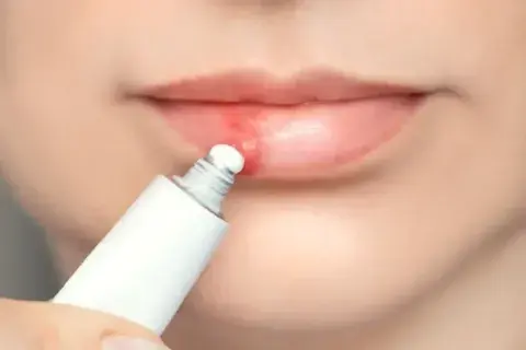 calentura labial