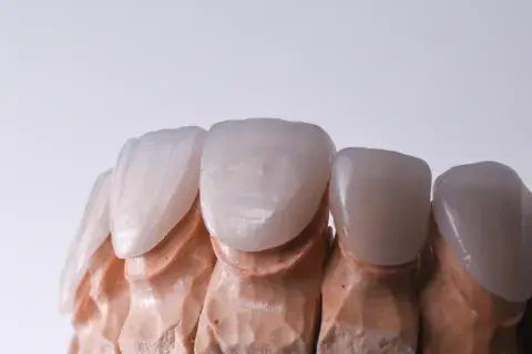 carillas-coronas-dentales