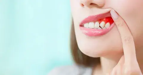 mujer con gingivitis
