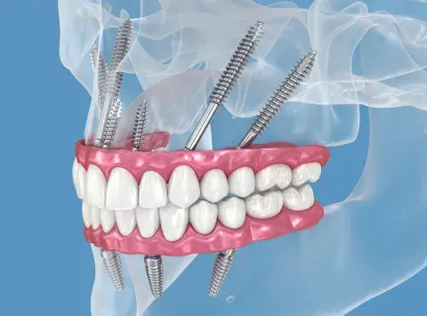 implantes-cigomaticos