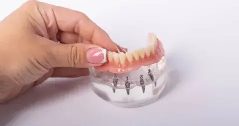 Implantes All-on-4 y All-on-6