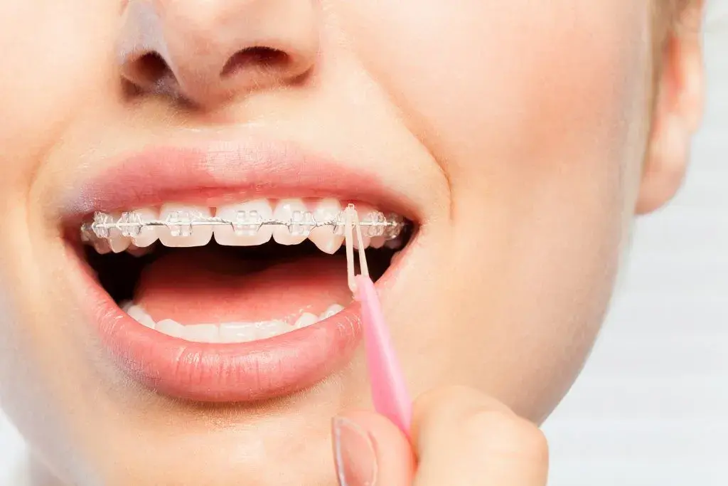 ¿Se pueden blanquear las gomas de los brackets?