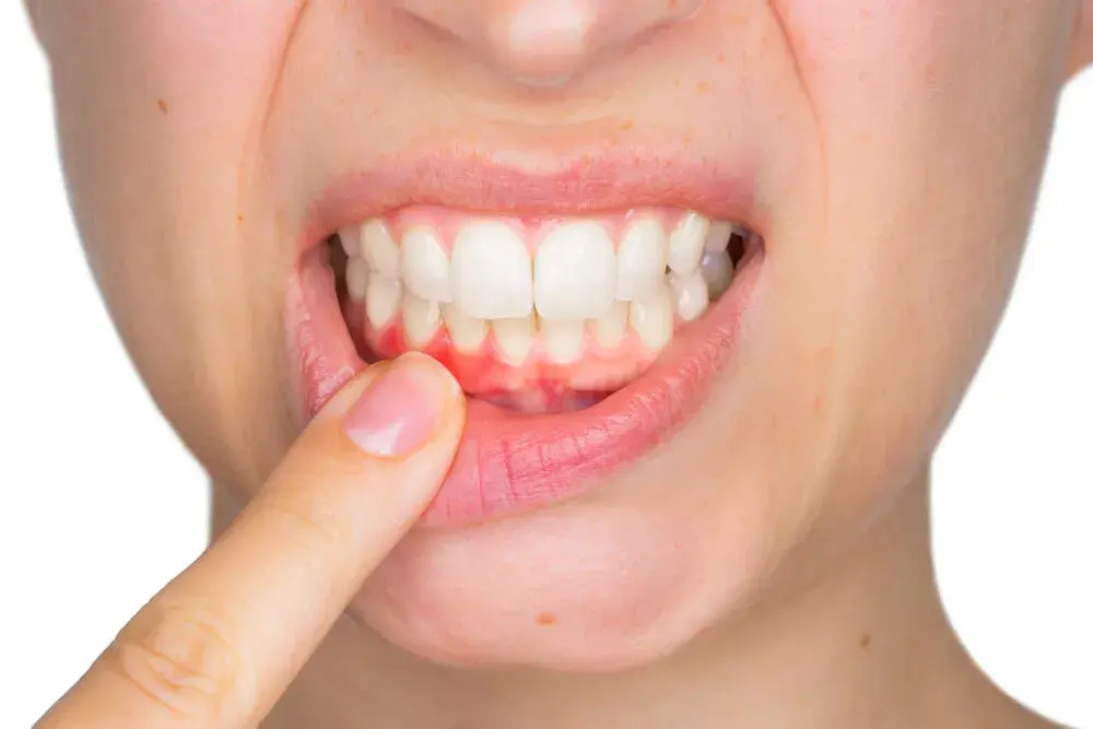 ¿Me pueden hacer una endodoncia teniendo un flemón?