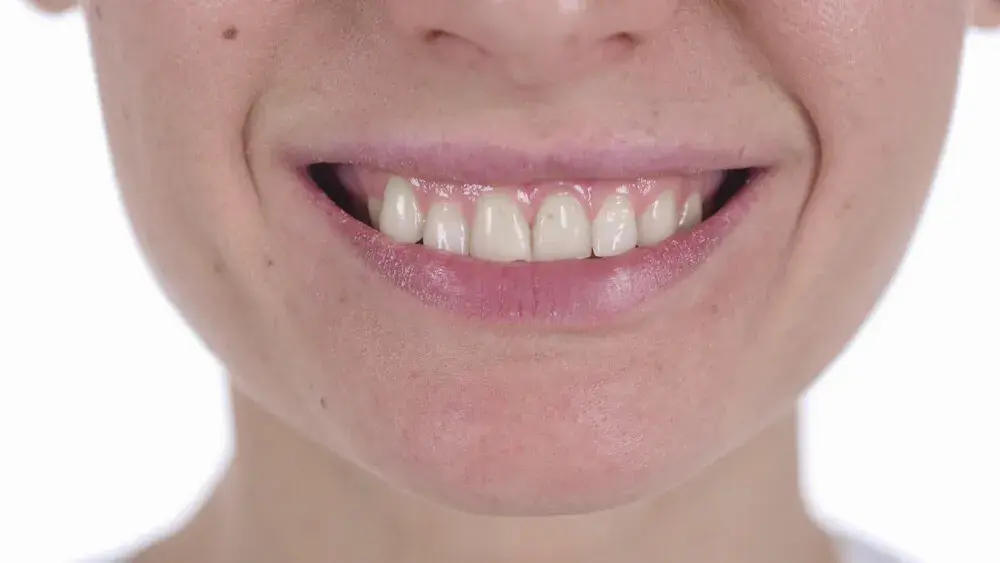 Manchas blancas en dientes y encías: causas
