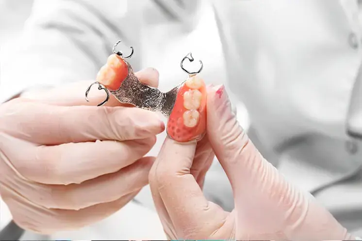¿Cuánto dura un puente dental?