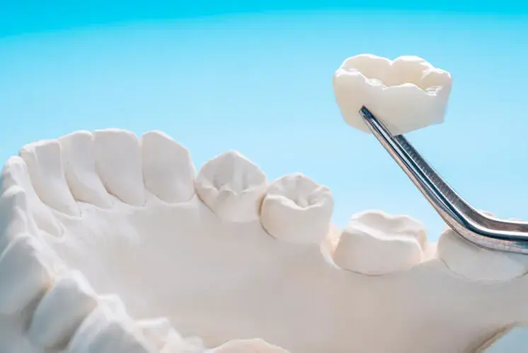 Las coronas de zirconio y que pasos requieren