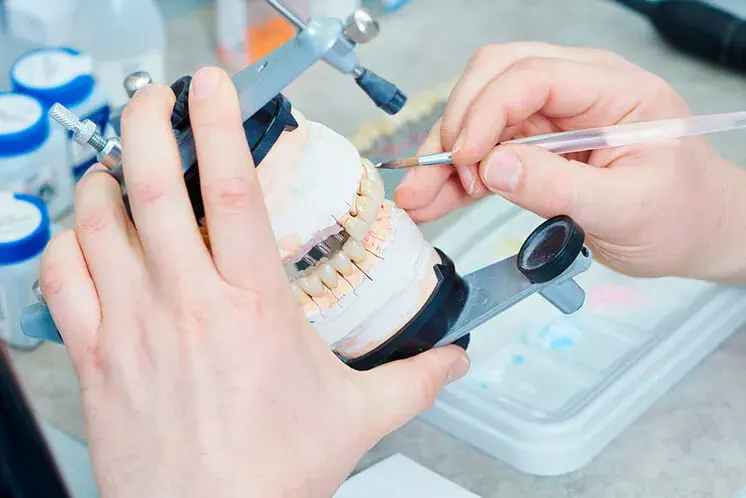 Tipos de puentes dentales: diferencias y beneficios