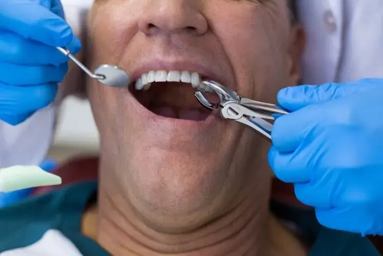 Extracción de cordales: ¿qué dientes son?