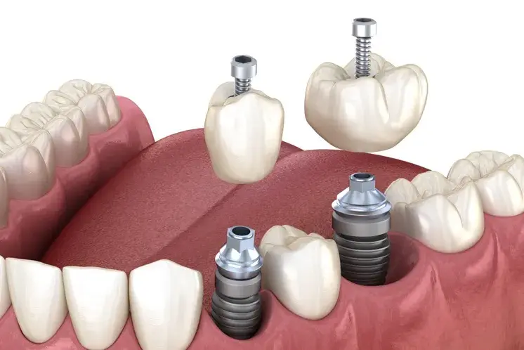 Aditamentos protésicos para implantes ¿Qué son?