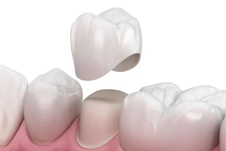 ¿Para qué sirve una funda dental?