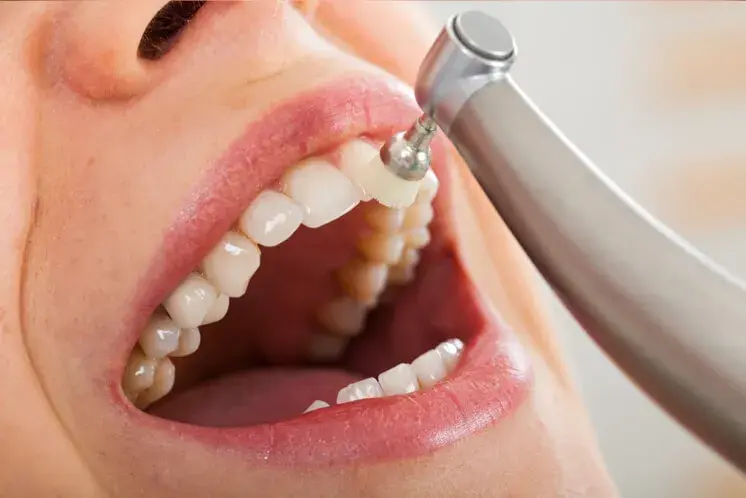 Qué es y cómo funciona la Profilaxis Dental