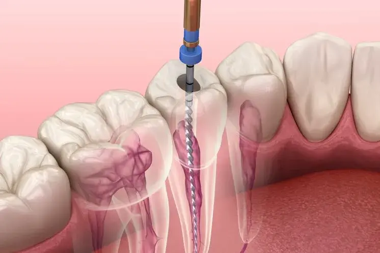 Endodoncia unirradicular: qué es y cuándo es necesaria
