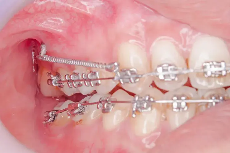 ¿Qué son los microimplantes dentales?