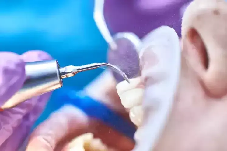 En qué consiste la Limpieza Dental por Ultrasonido