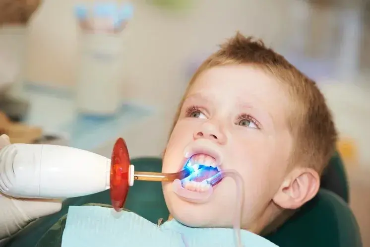 Qué es un sellado dental y cuándo es necesario