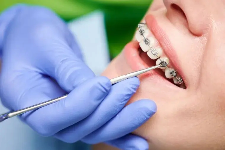 ¿Duele el ajuste de brackets?
