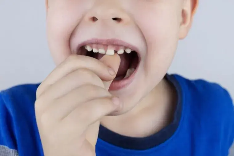 Caída de los dientes de leche: ¿Qué lo provoca?