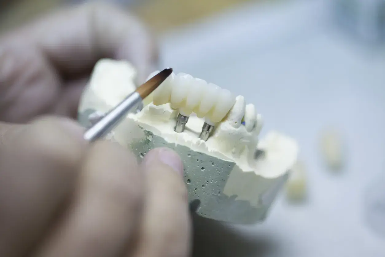 Los diferentes materiales para coronas y puentes sobre implantes