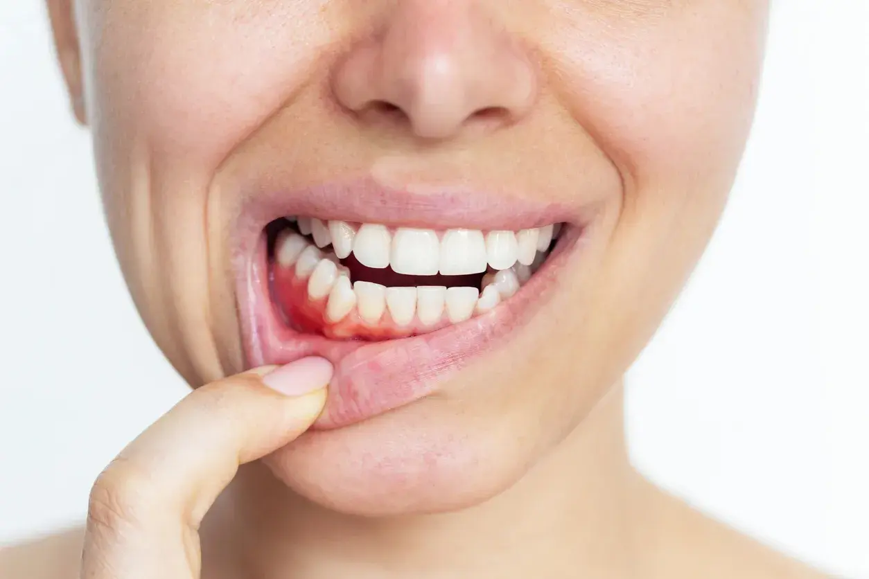 ¿Cómo se curan la gingivitis y periodontitis?