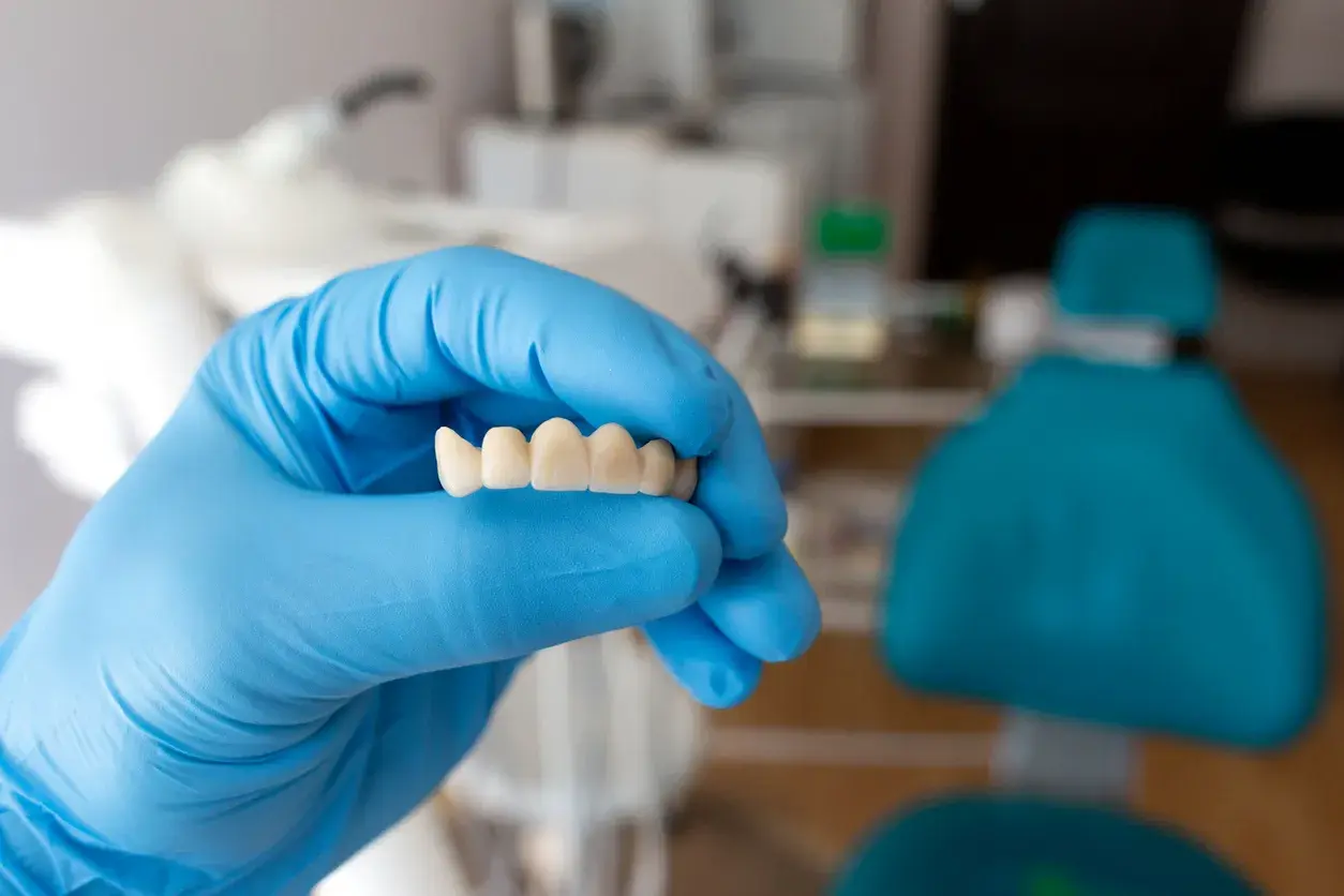 Puentes: diferencia y ventajas de los implantes sobre los puentes