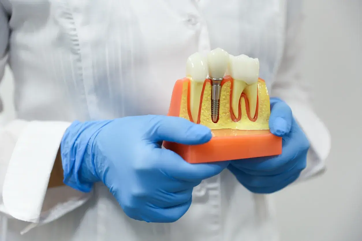 10 razones para elegir implantes dentales en lugar de prótesis removibles