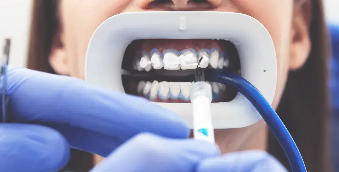 Blanqueamiento en dientes vitales 