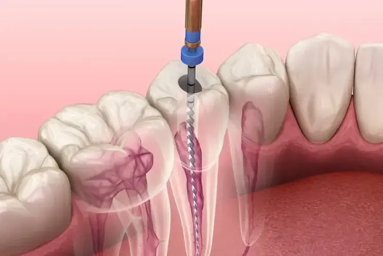 Endodoncia unirradicular.
