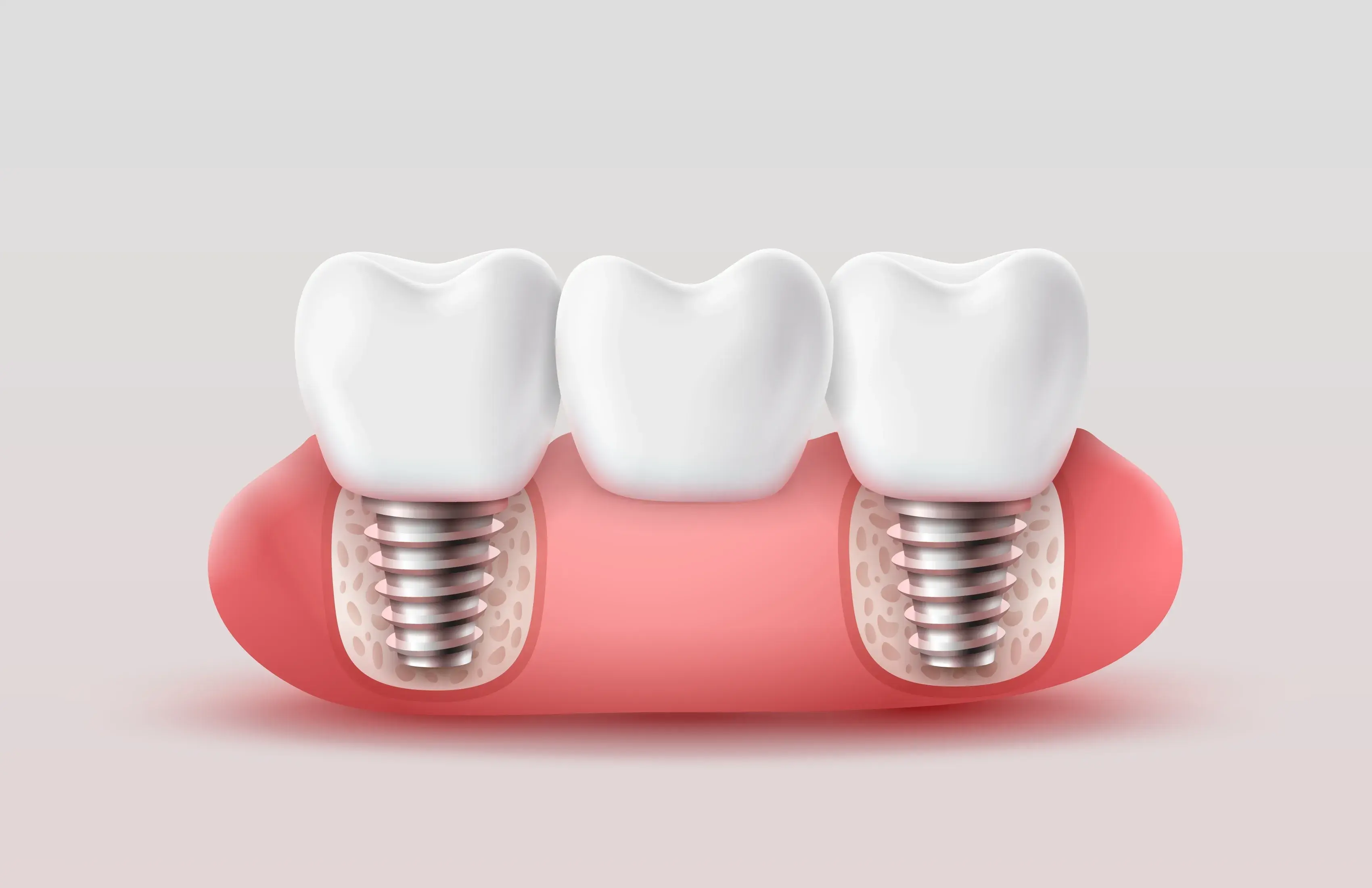 Implantes cortos