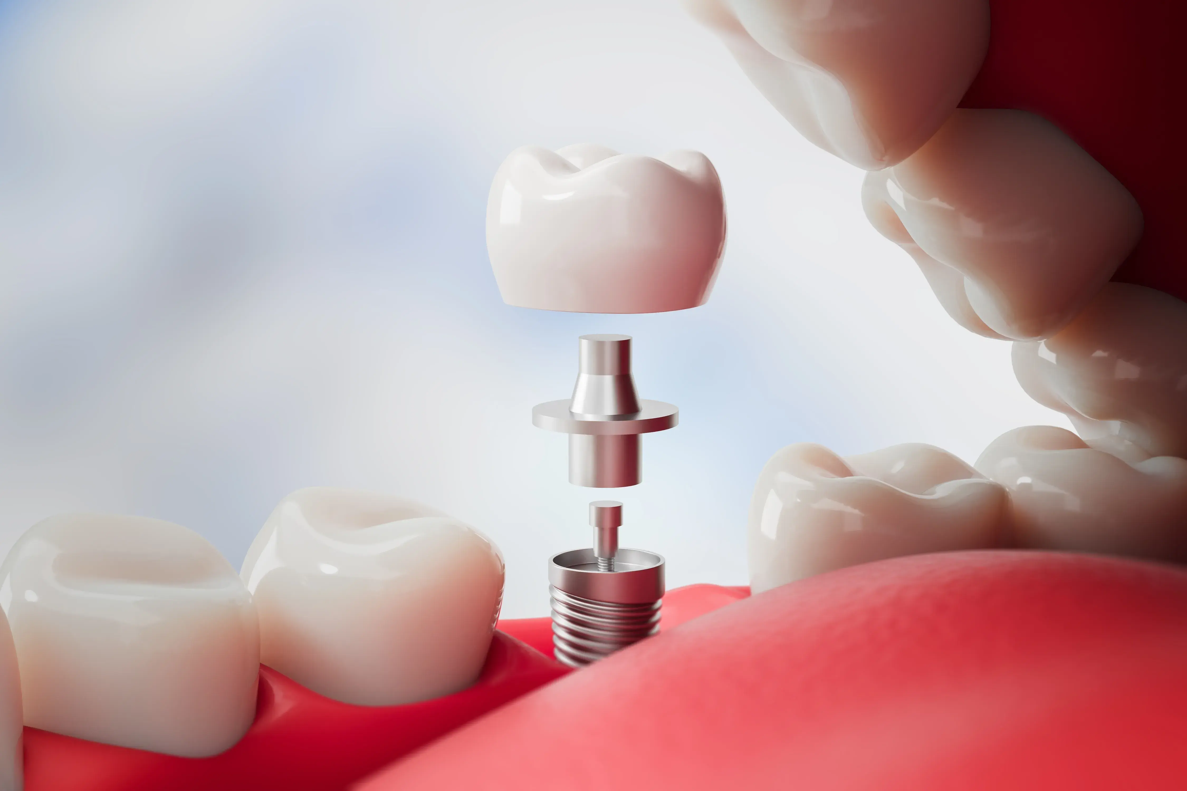 Implantes de titanio
