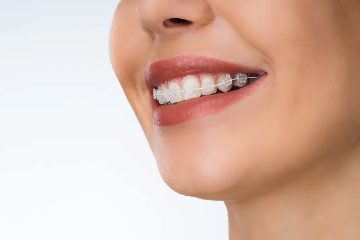 Brackets de zafiro y brackets de cerámica: qué debes tener en cuenta