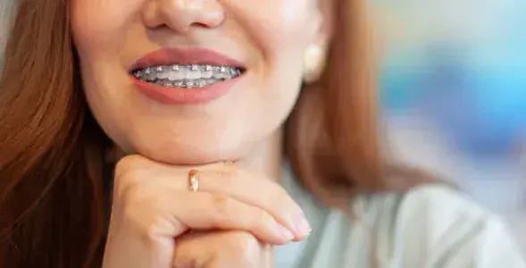 Brackets autoligables metálicos