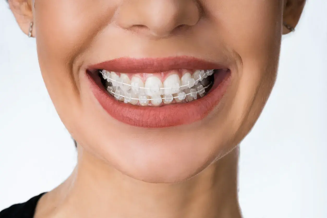 Razones para usar brackets de porcelana
