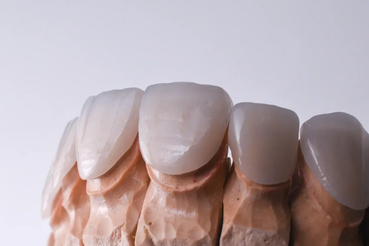 Diferencias entre carillas y coronas dentales