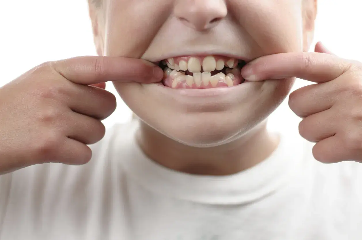 Dientes chuecos: causas y tratamiento