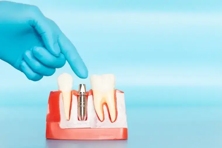 Historia y evolución de los implantes dentales