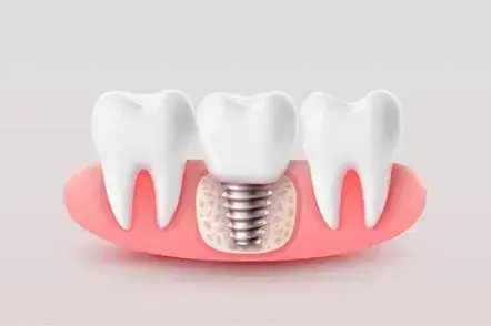 Prótesis fija sobre Implantes de zirconio