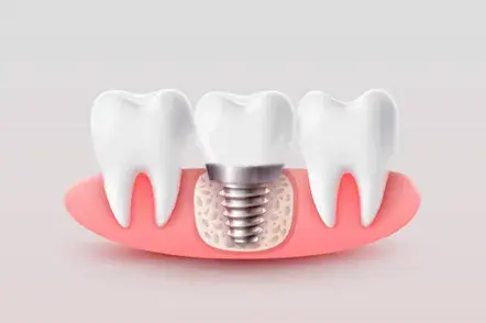 Implante Corona Metal Porcelana