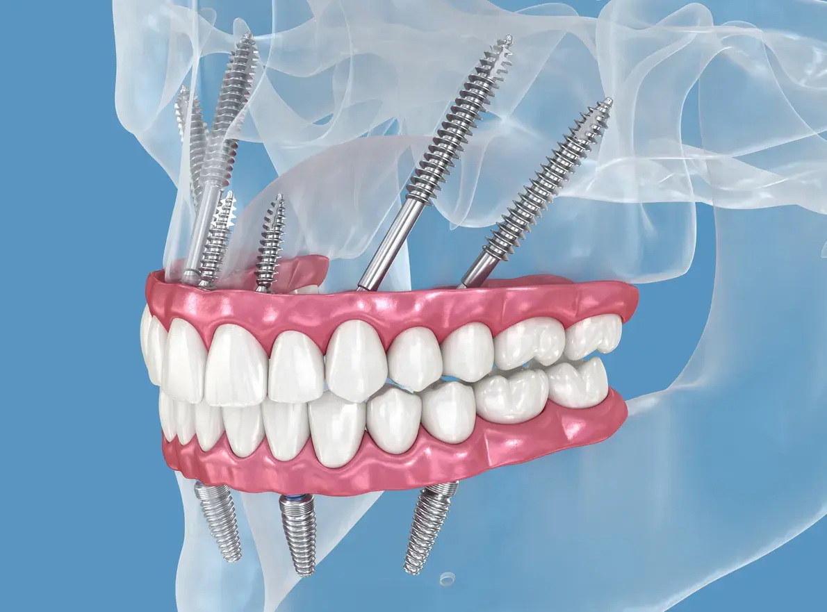 Qué son los implantes cigomáticos y cuáles son sus ventajas