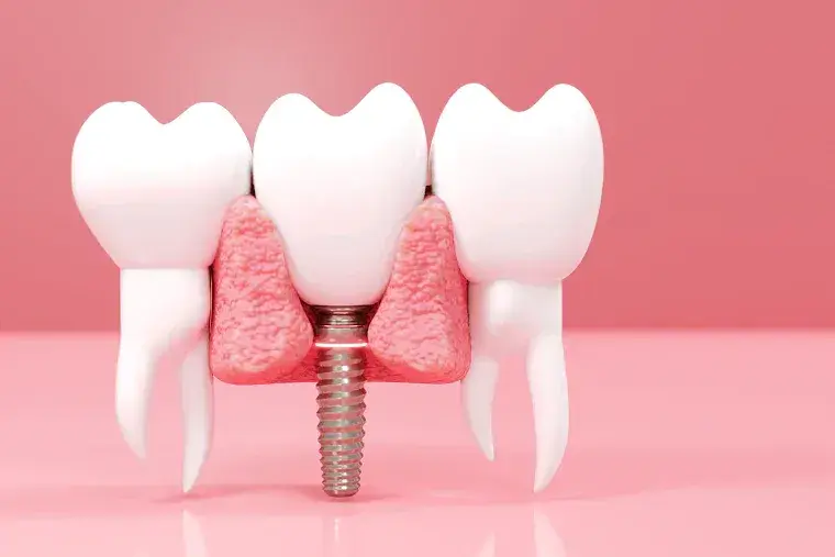 Implantes dentales: las últimas investigaciones en implantología