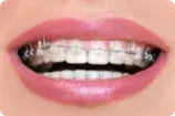 Ortodoncia autoligables esteticos